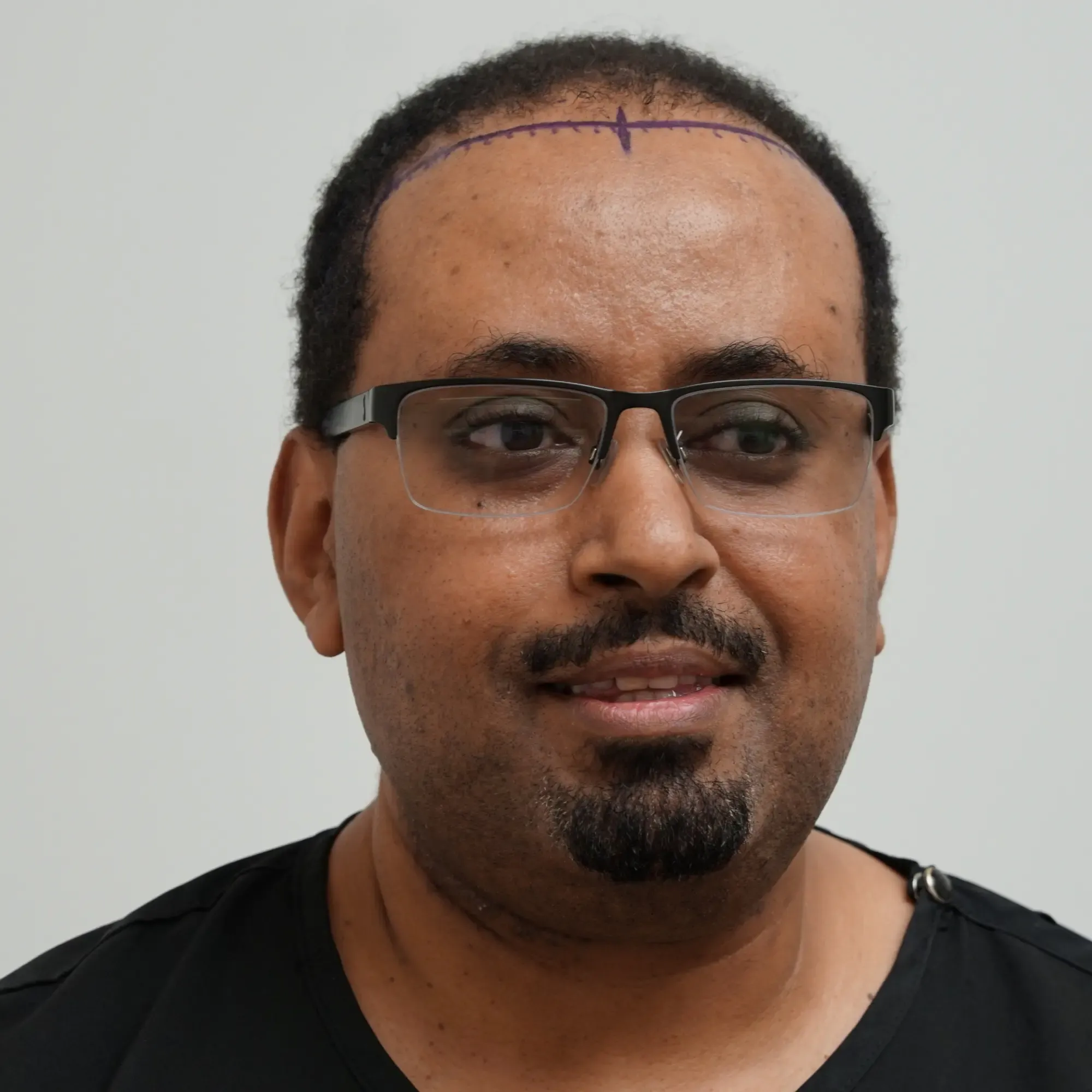A patient with afro-textured hair before a hair transplant at Vera Clinic