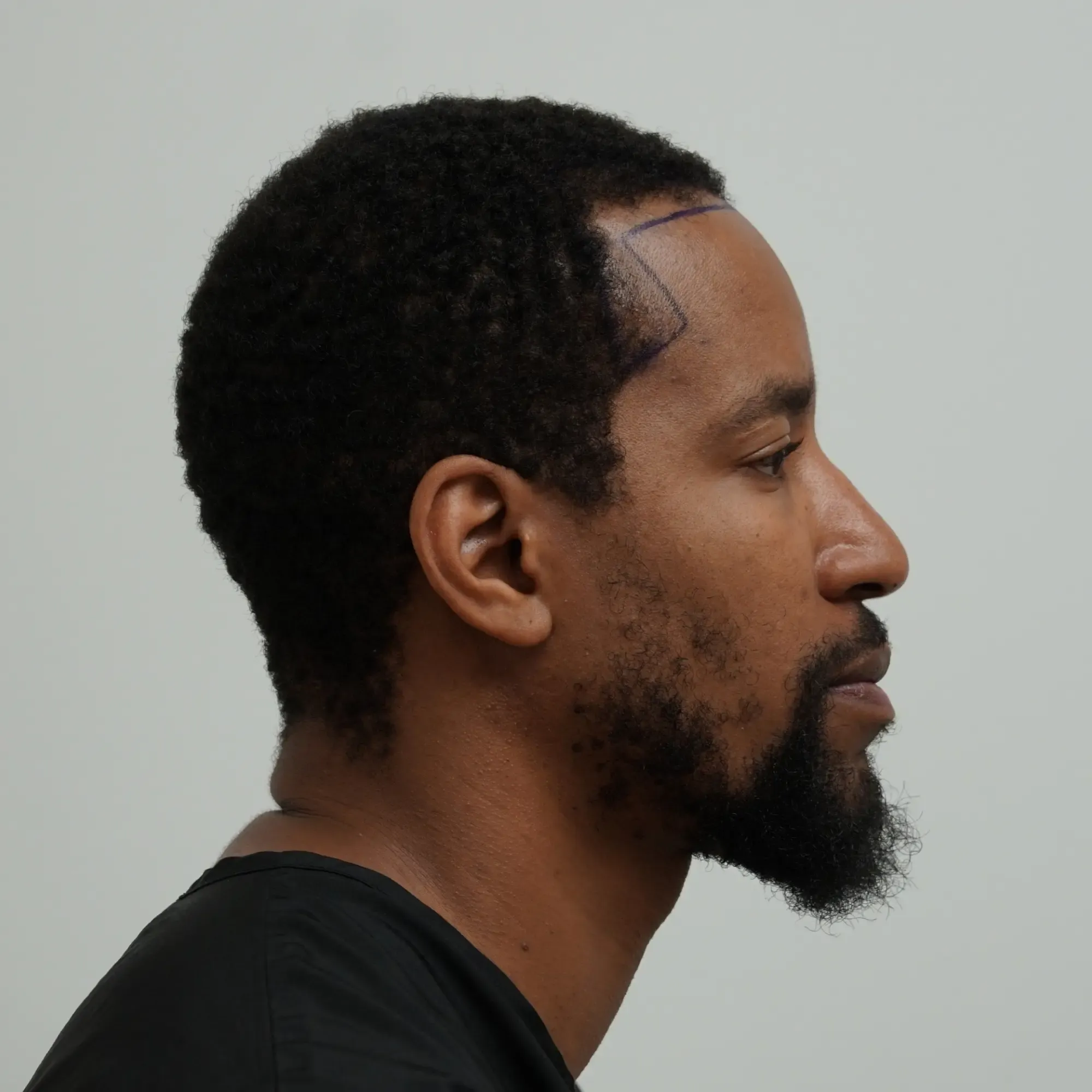 A patient with afro-textured hair before a hair transplant at Vera Clinic