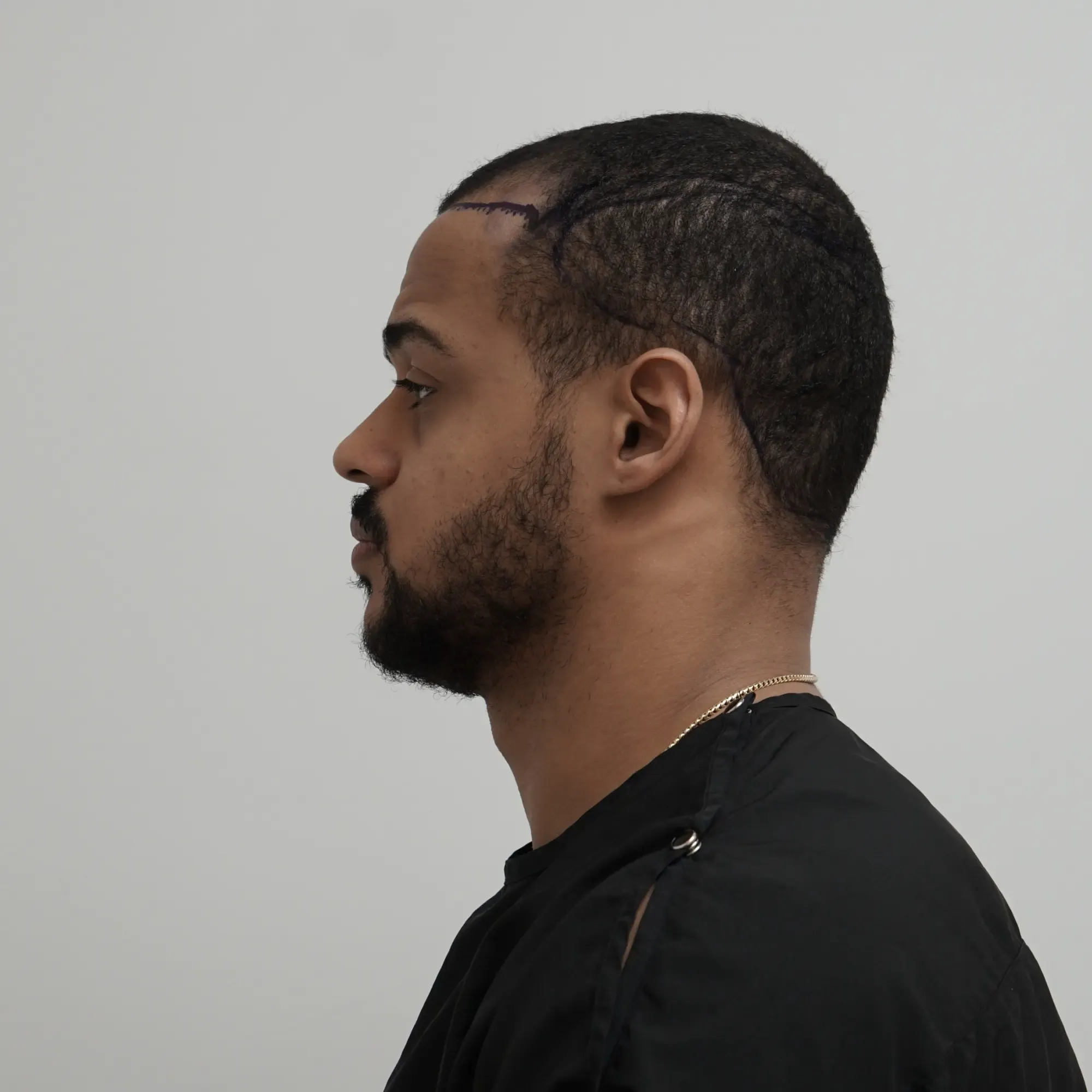 A patient with afro-textured hair before a hair transplant at Vera Clinic