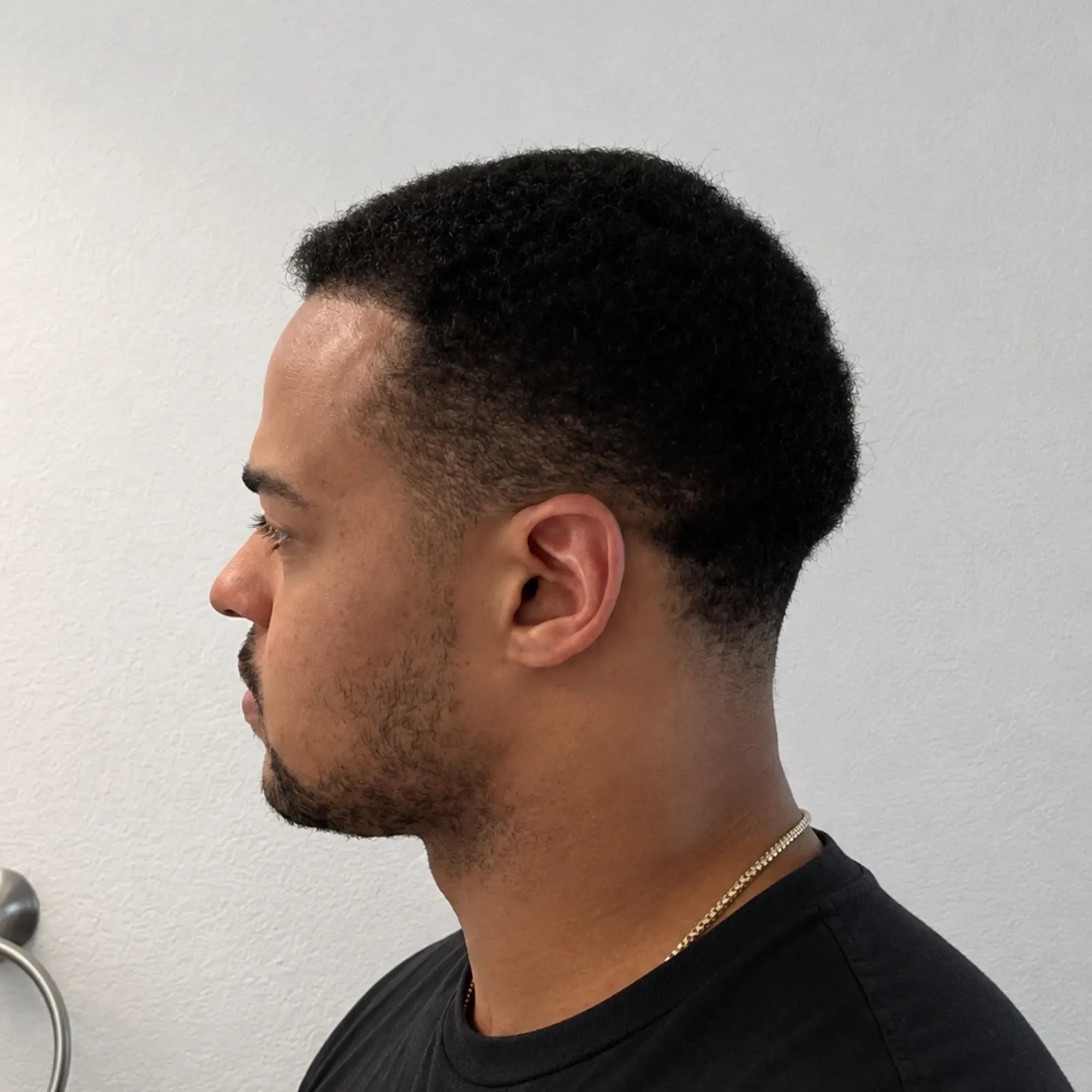 The same patient 12 months after a 4,700 graft hair transplant at Vera Clinic