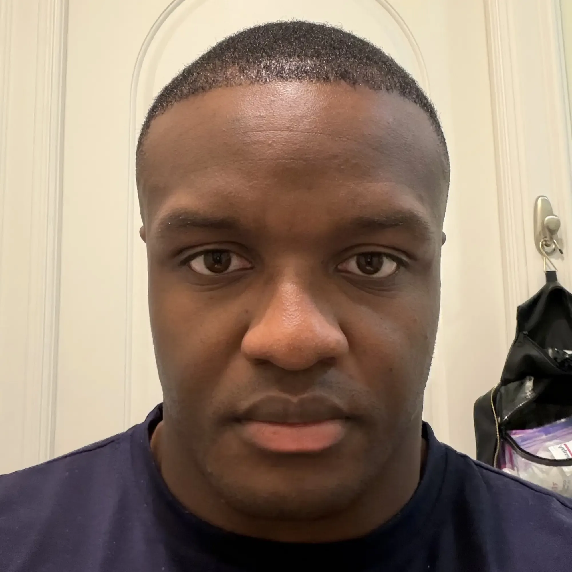 The same patient 9 months after a 2,500 graft hair transplant at Vera Clinic