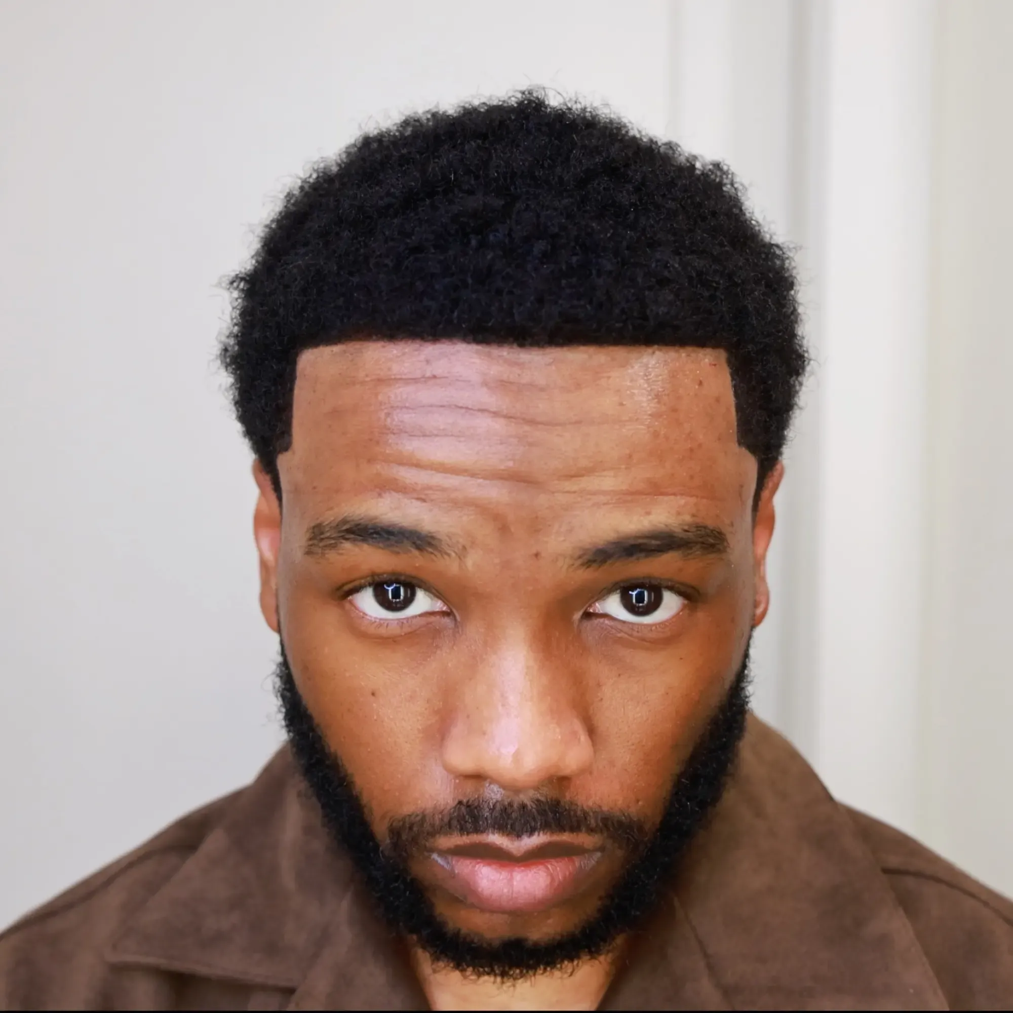 The same patient 8 months after a 2,400 graft hair transplant at Vera Clinic