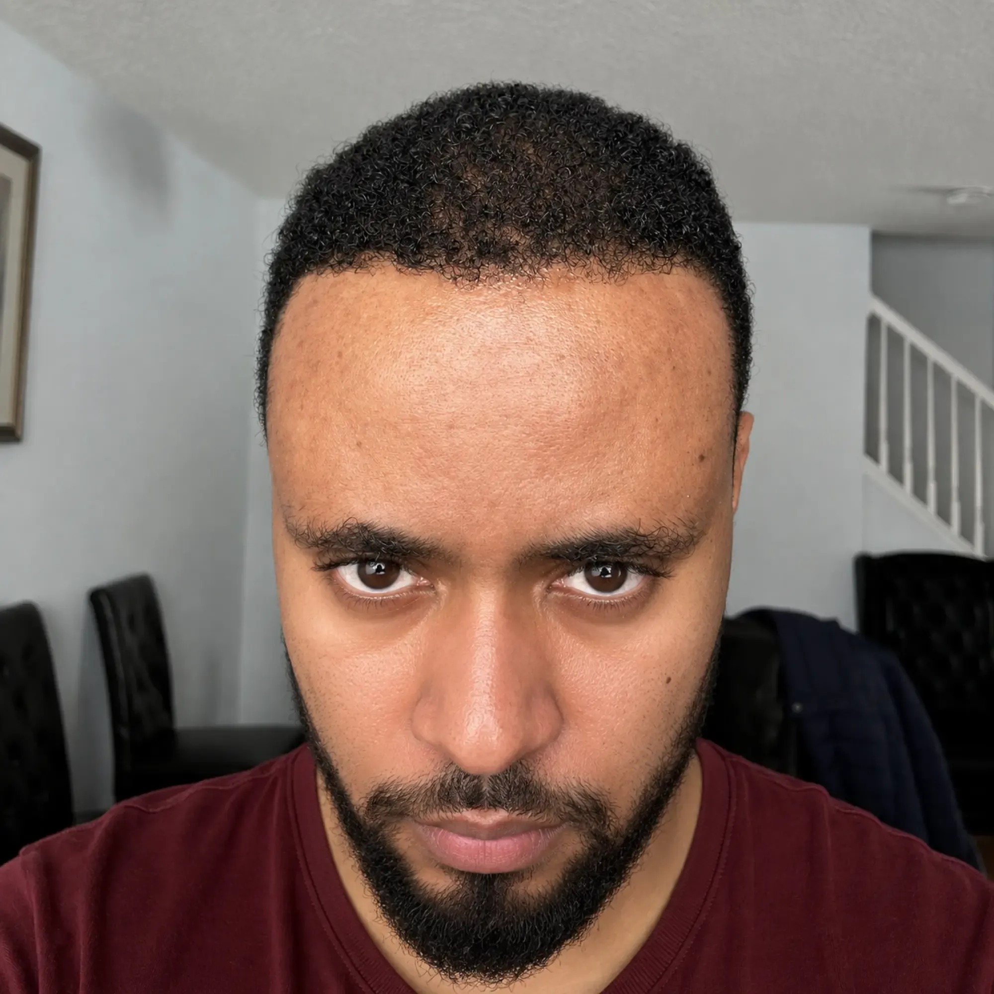 The same patient 8 months after a 3,800 graft hair transplant at Vera Clinic