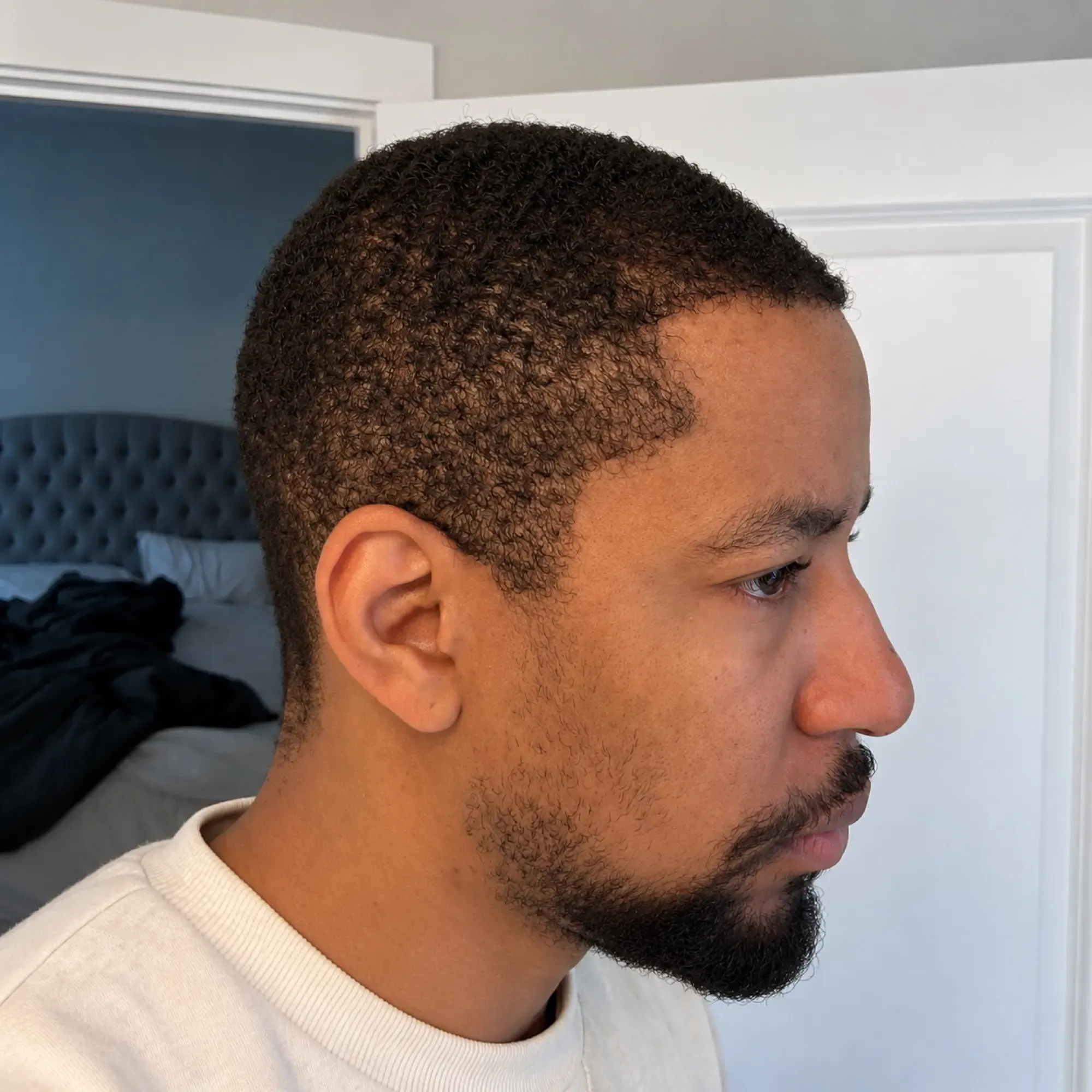 The same patient 8 months after a 2,900 graft hair transplant at Vera Clinic