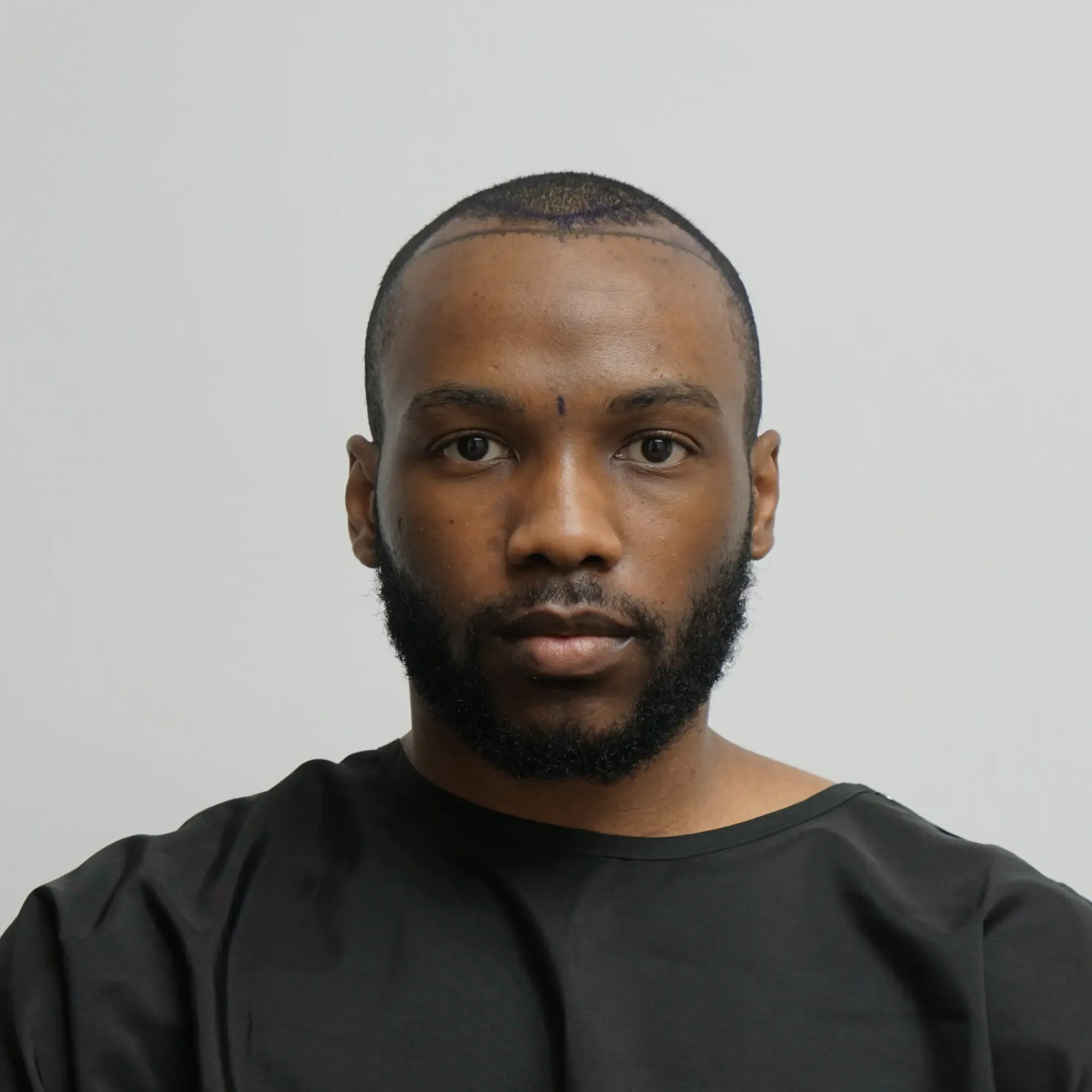A patient with afro-textured hair before a hair transplant at Vera Clinic