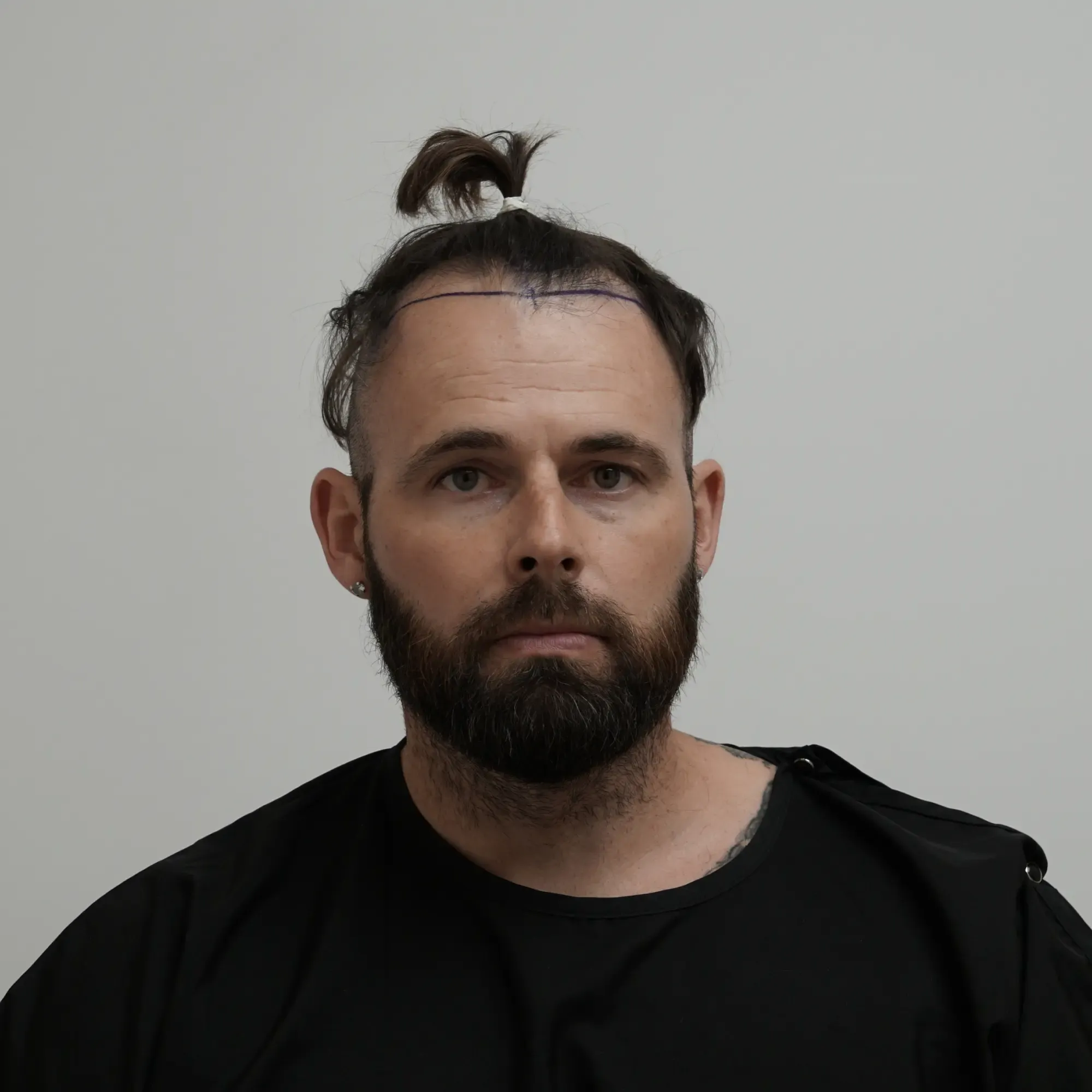 Patient before a hair transplant at Vera Clinic