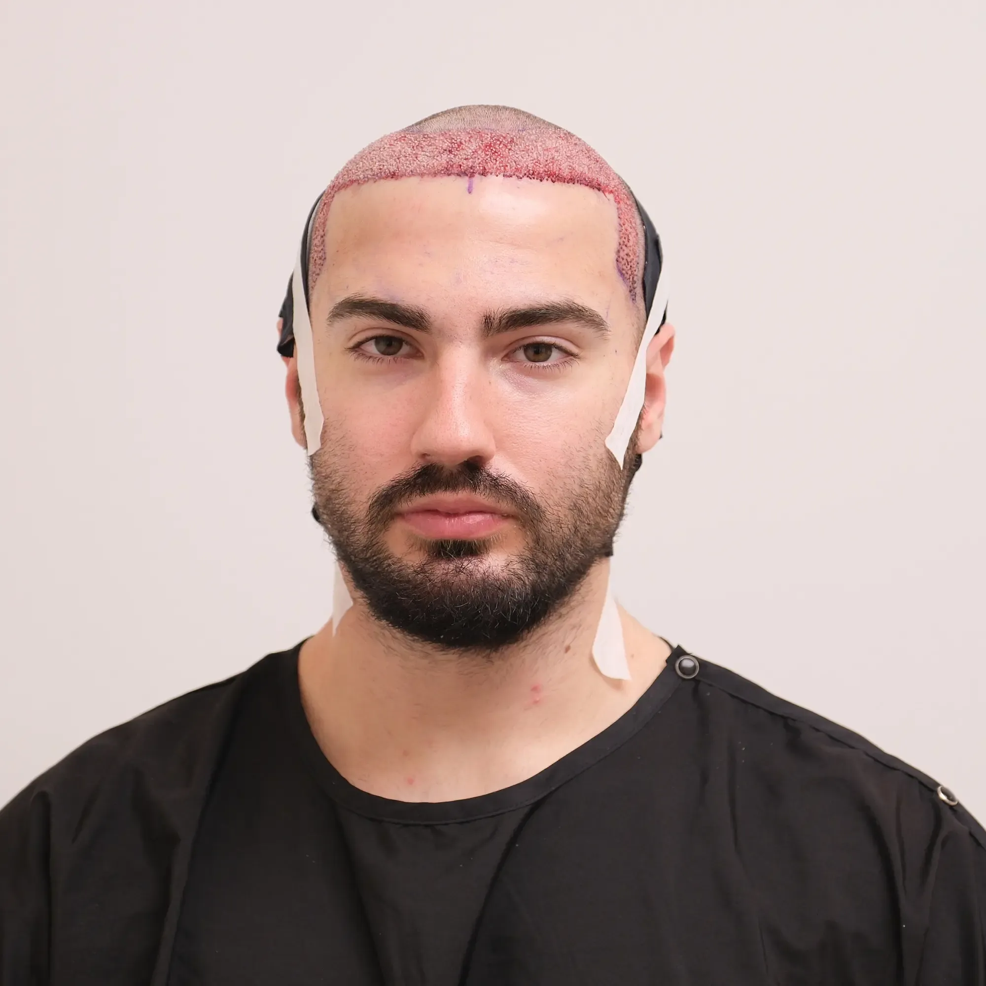 Patient before a hair transplant at Vera Clinic