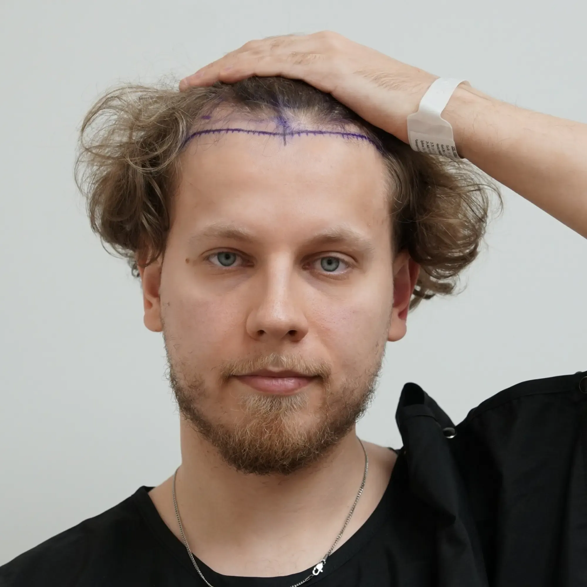 Patient before a hair transplant at Vera Clinic