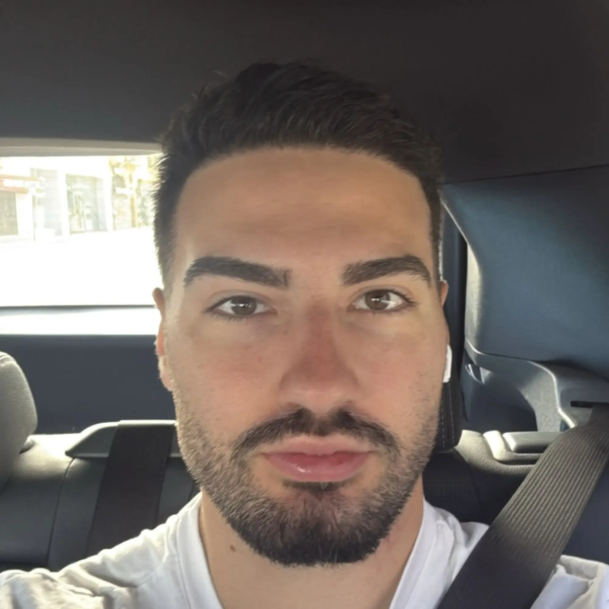 The same patient 6 months after a 3,500 graft hair transplant at Vera Clinic