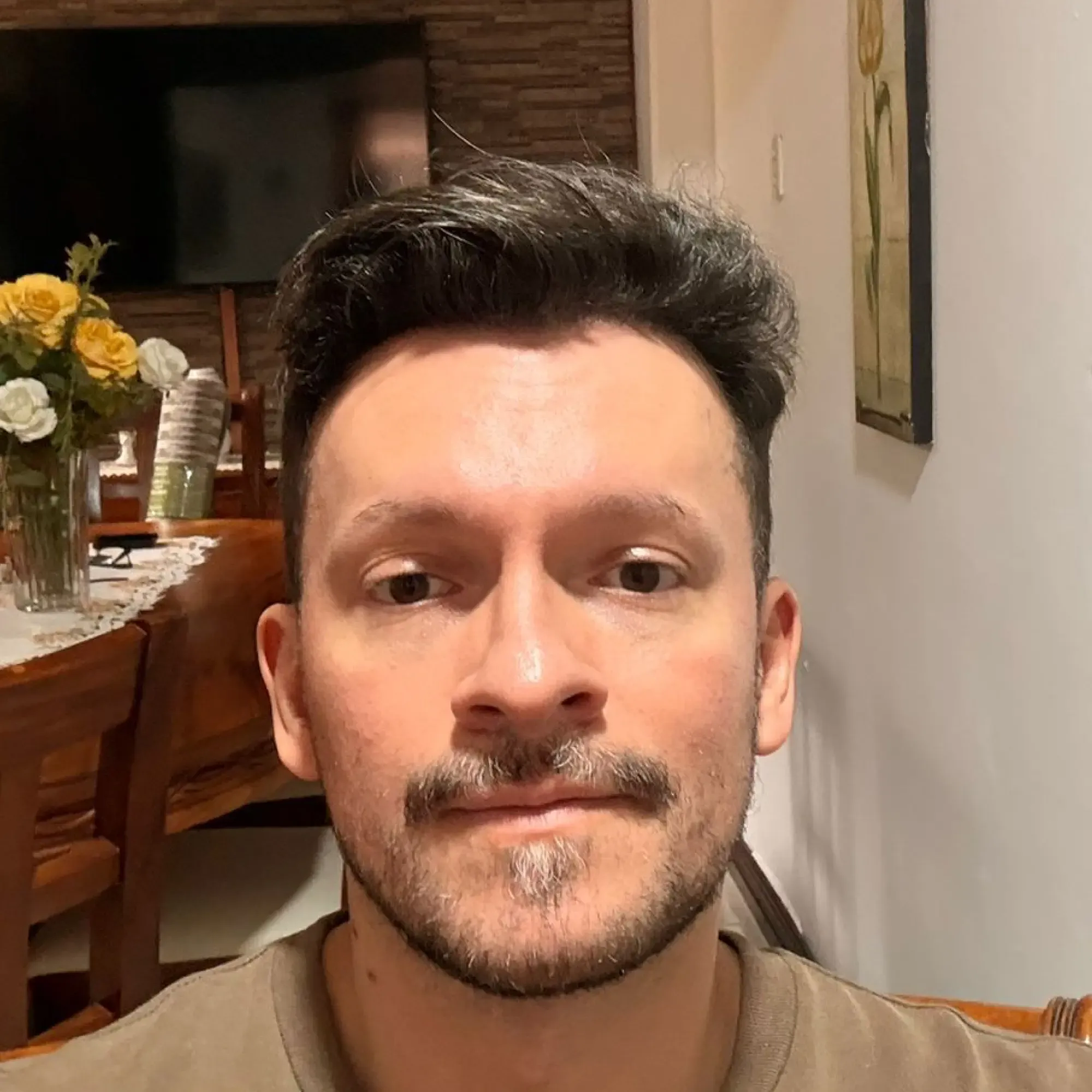 The same patient 8 months after a 2,800 graft hair transplant at Vera Clinic
