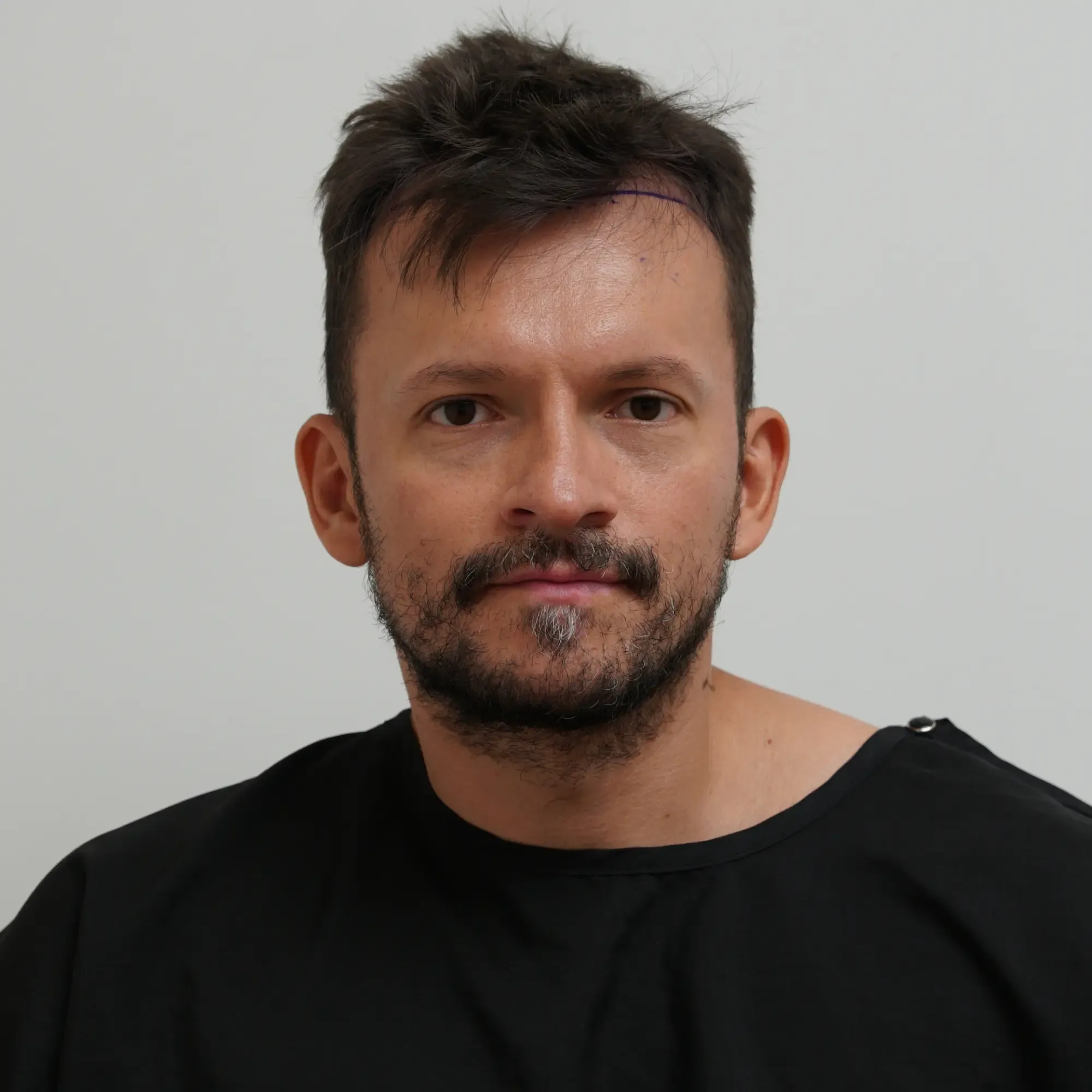 Patient before a hair transplant at Vera Clinic