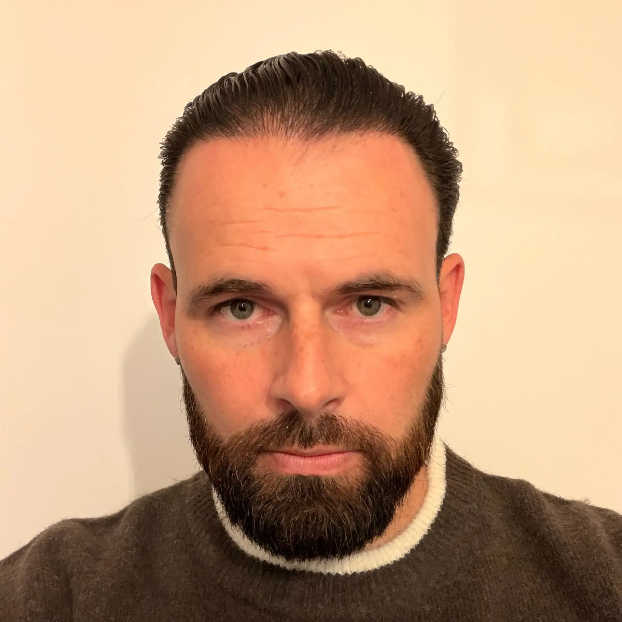 The same patient 12 months after a 4,400 graft hair transplant at Vera Clinic