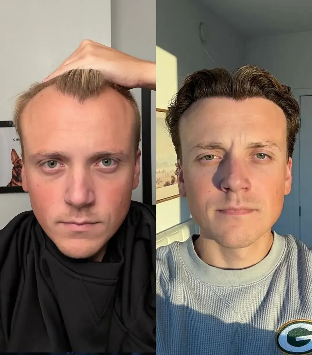 Vera Clinic Patient T.W. — Vorher und Nachher der Haartransplantation