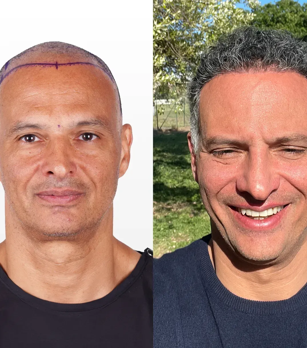 Vera Clinic Patient J.S. — Vorher und Nachher der Haartransplantation