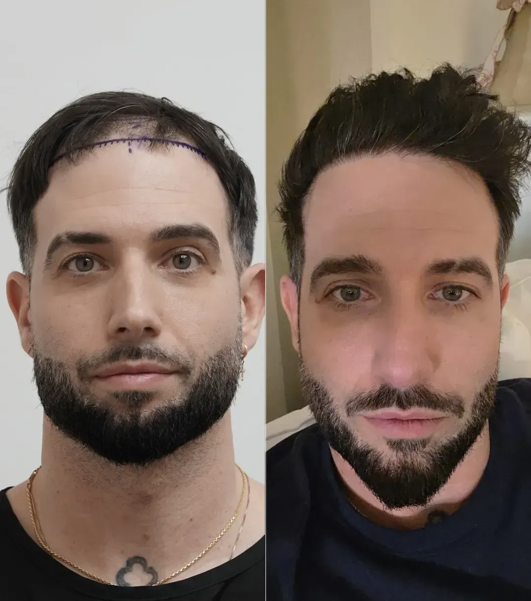 Vera Clinic Patient M.K. — Vorher und Nachher der Haartransplantation