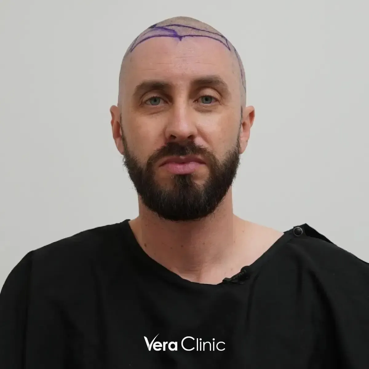 Patient before a 4,000-graft Hyper DHI procedure