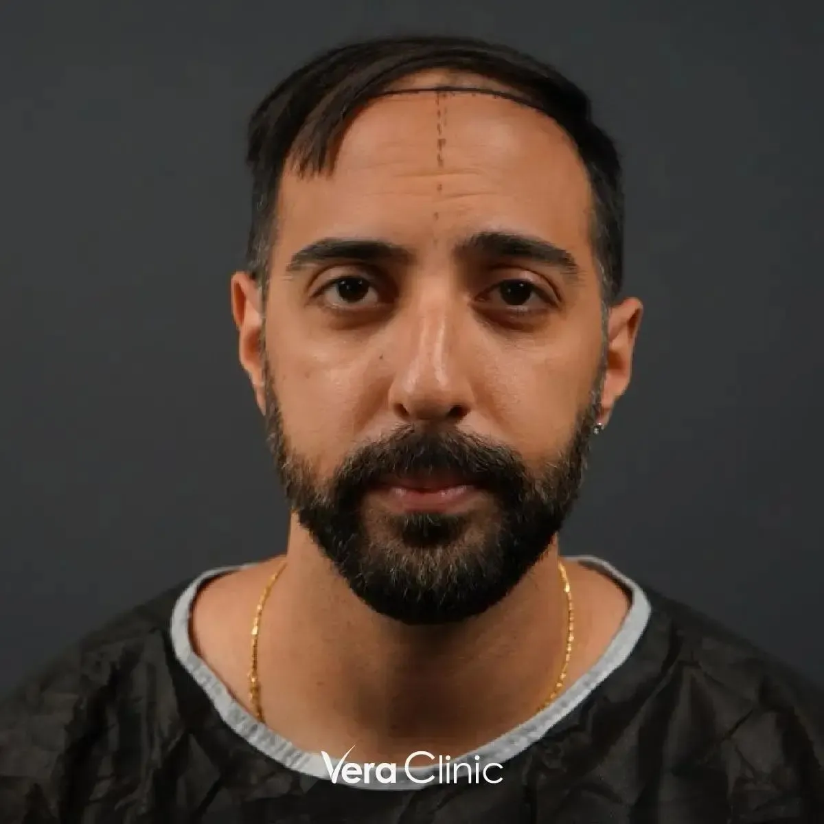 Patient before a 5,000-graft Sapphire FUE procedure