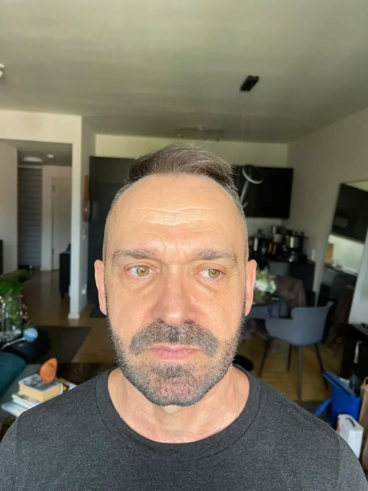 Before hair transplant