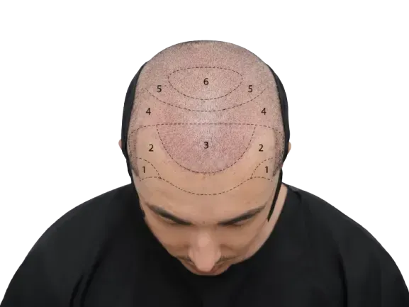 Scalp zones diagram
