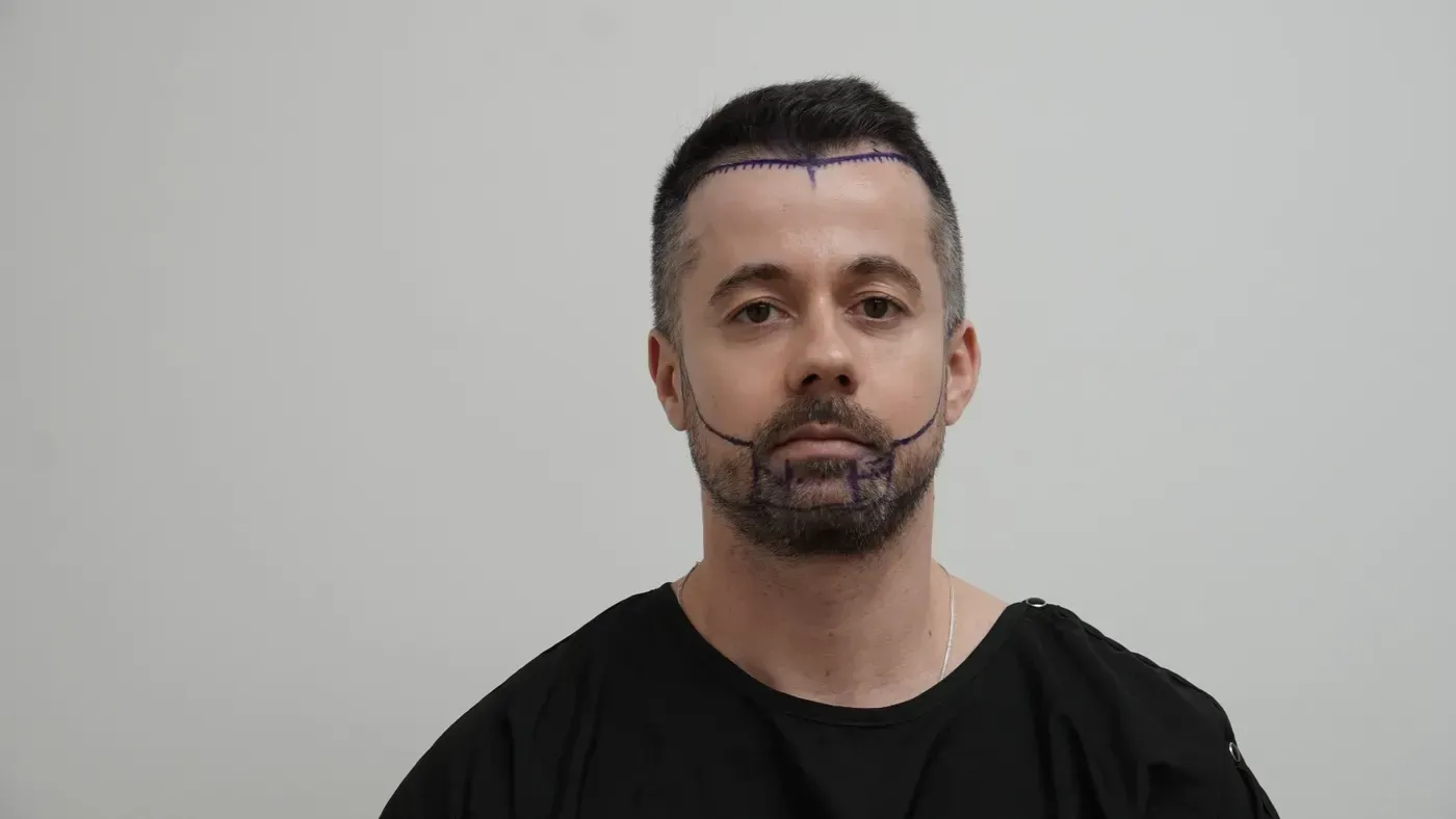 Before hair transplant