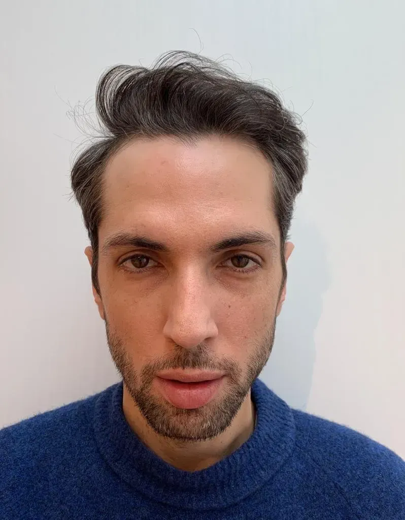 Before hair transplant