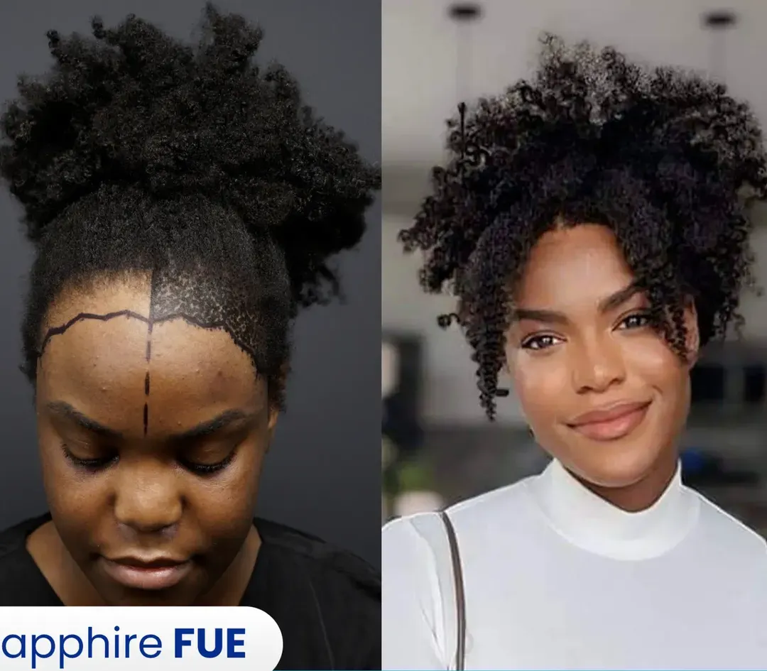 Female hair restoration result — 3,600 grafts