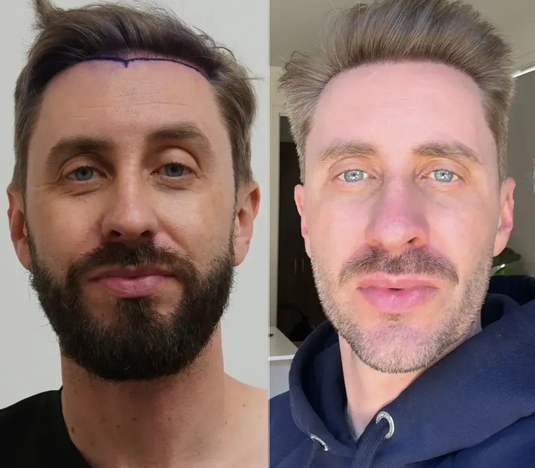 SAPPHIRE hair restoration result — 2,000 grafts