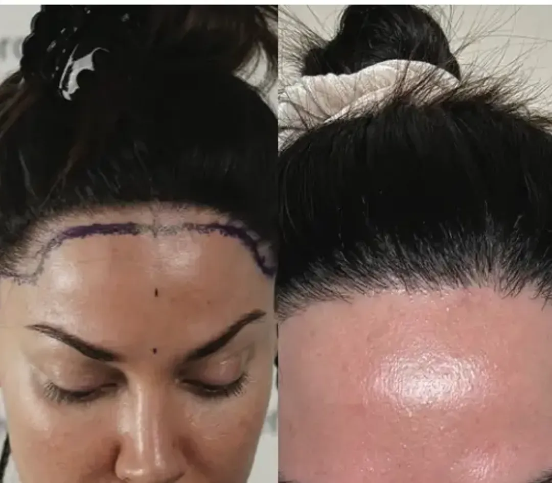 Female hair restoration result — 2,800 grafts