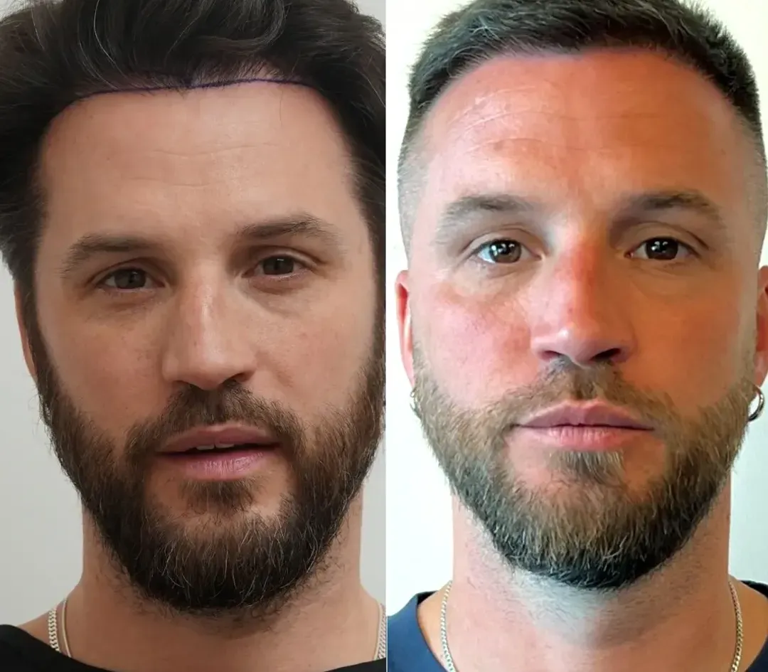 SAPPHIRE hair restoration result — 3,600 grafts