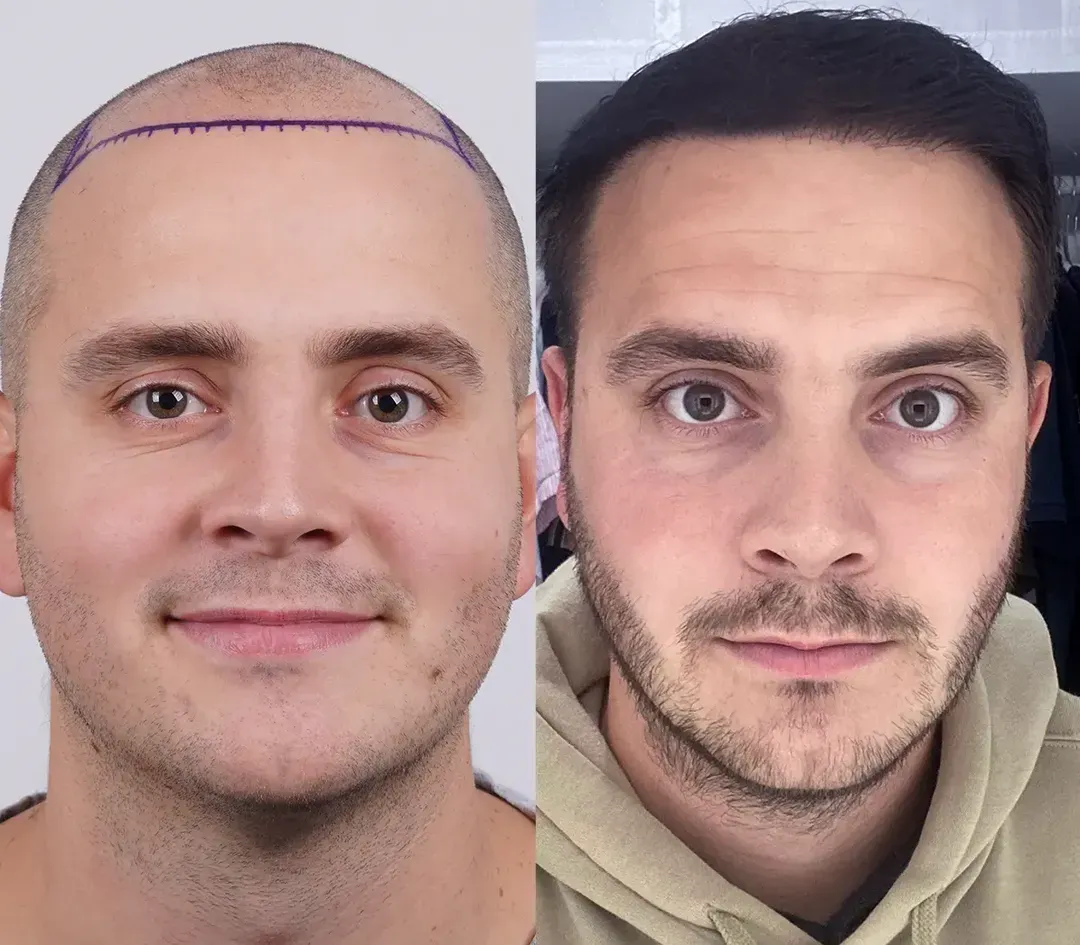 FUE hair restoration result — 4,000 grafts
