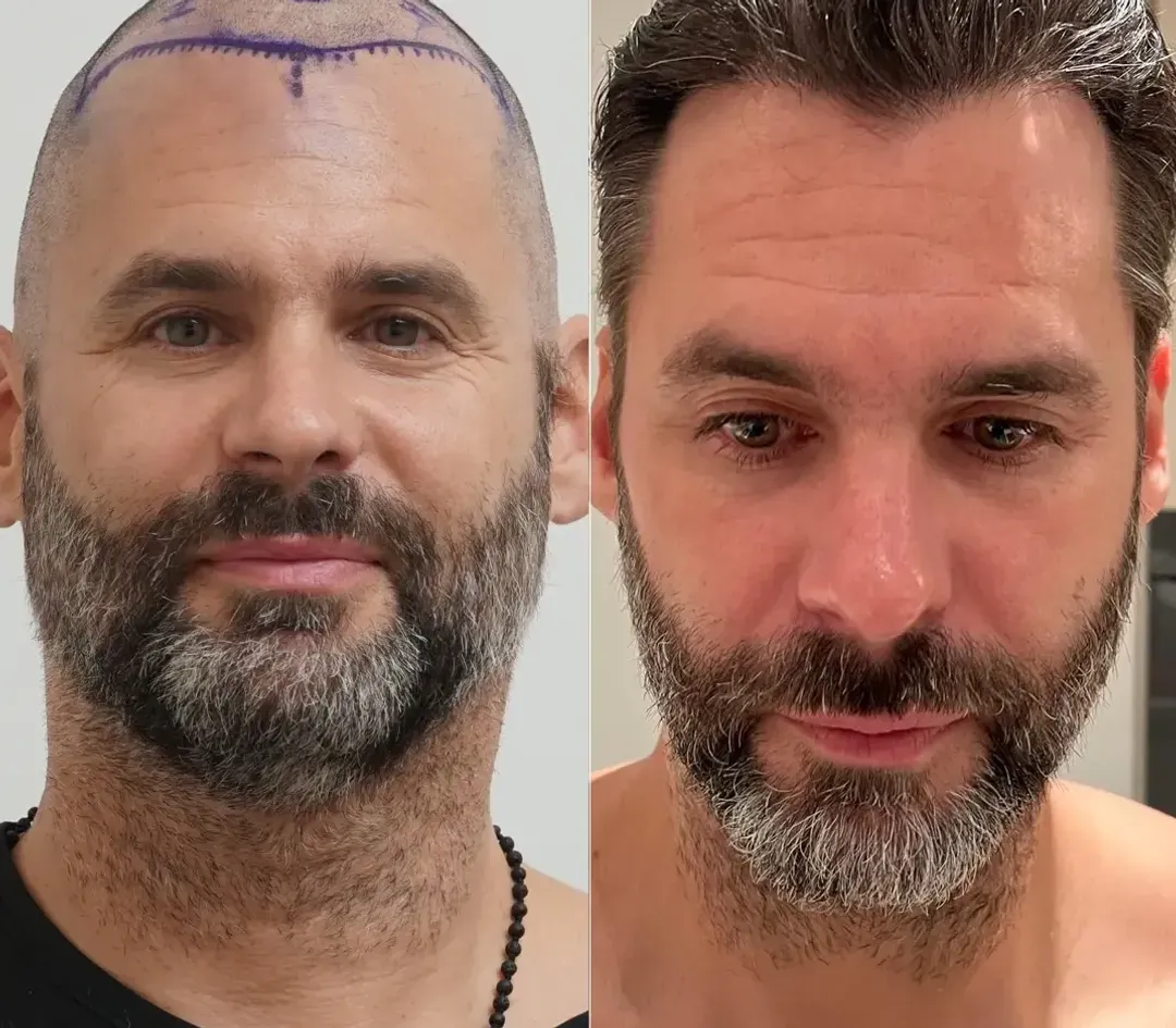 DHI hair restoration result — 2,800 grafts