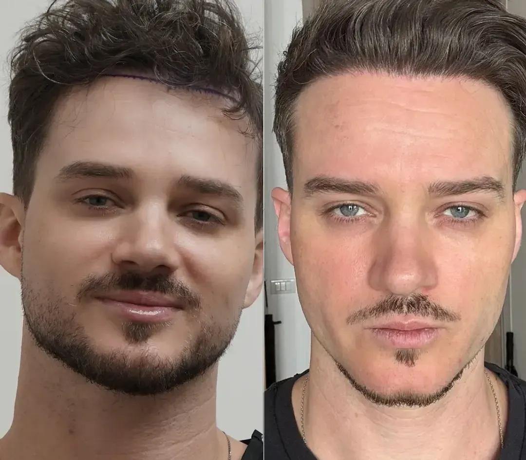 DHI hair restoration result — 4,000 grafts