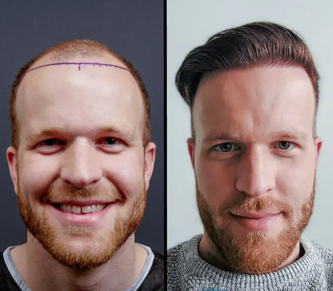 FUE hair restoration result — 2,800 grafts