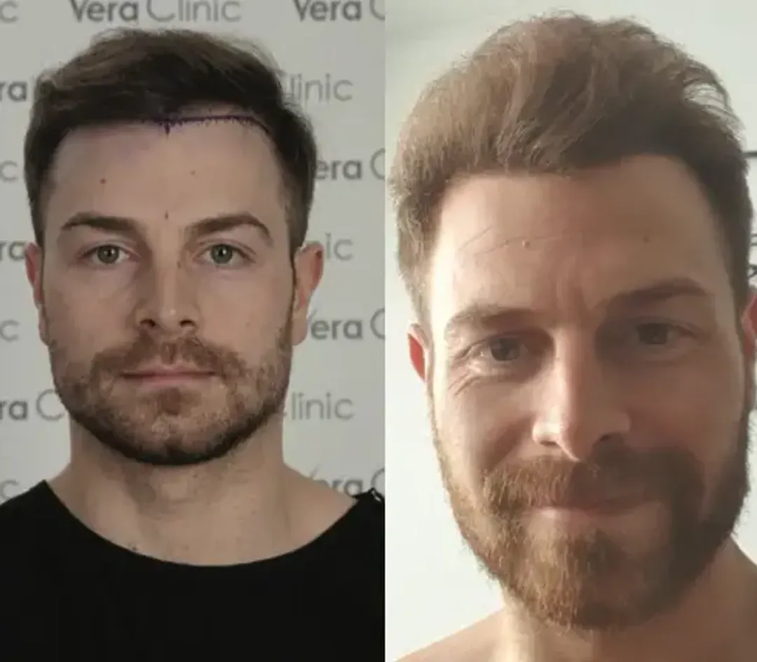 FUE hair restoration result — 3,600 grafts