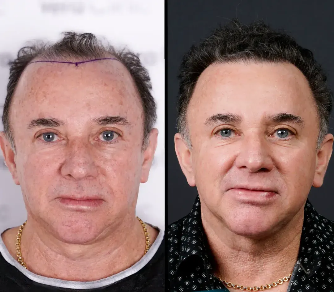FUE hair restoration result — 3,200 grafts