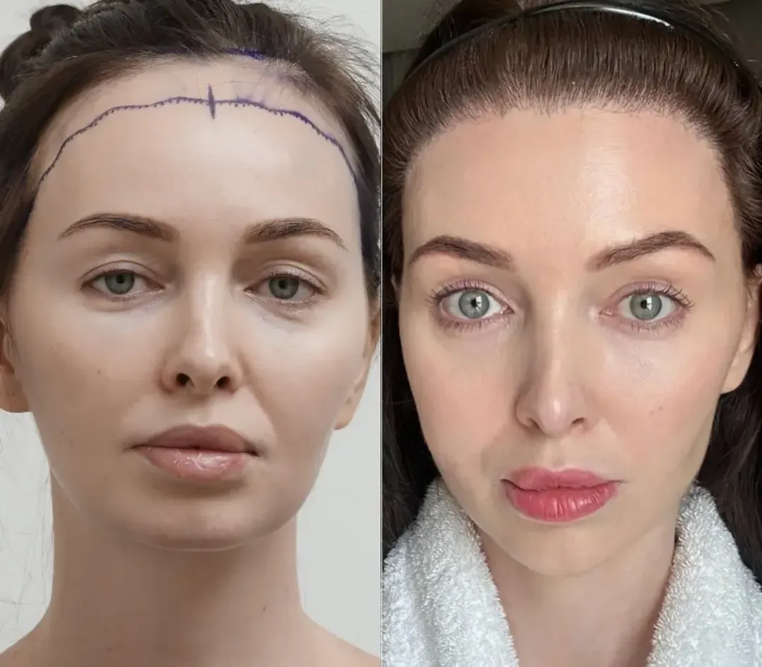 Female hair restoration result — 3,200 grafts