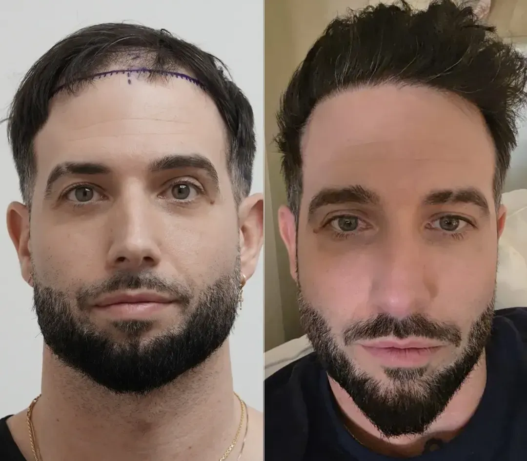 SAPPHIRE hair restoration result — 3,200 grafts