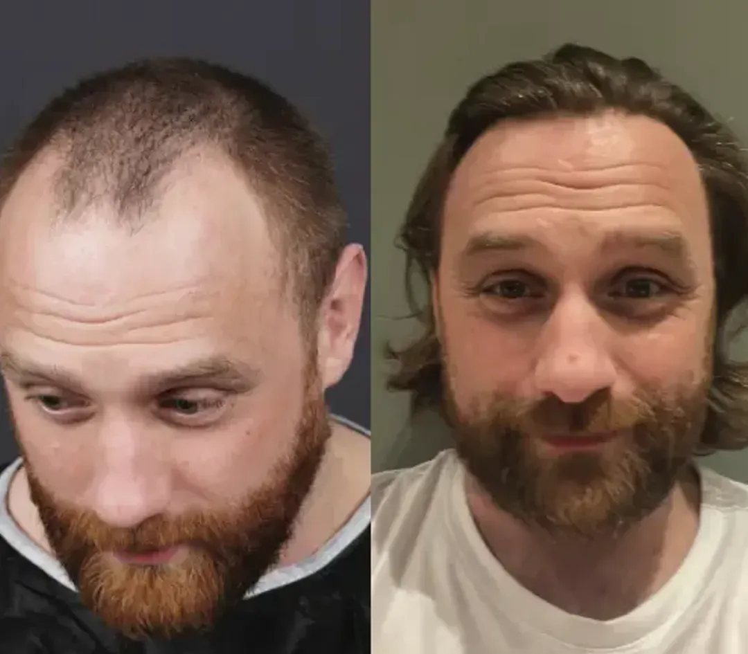 FUE hair restoration result — 2,000 grafts