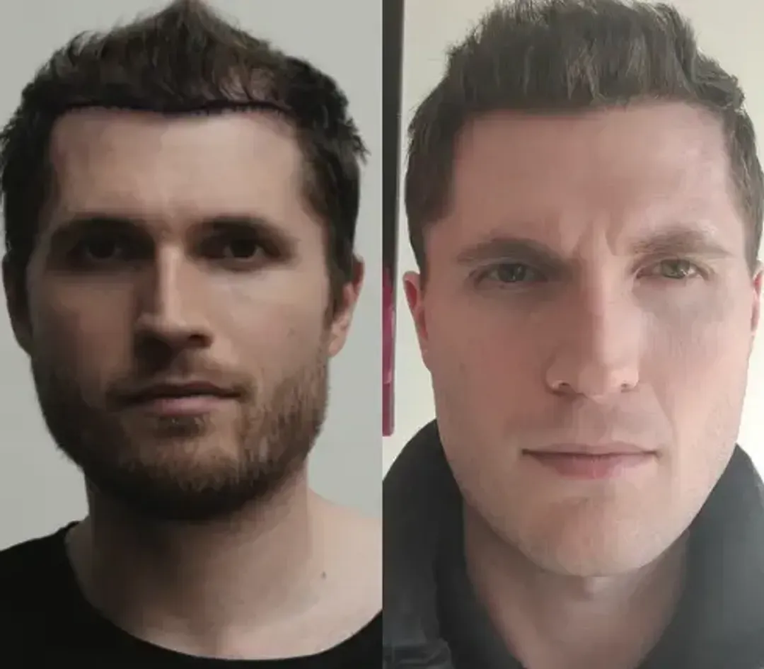 DHI hair restoration result — 3,600 grafts