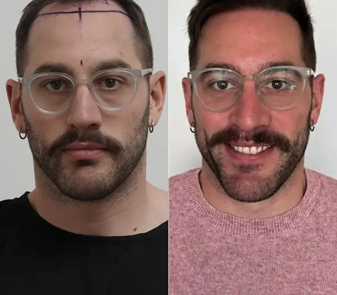 DHI hair restoration result — 2,000 grafts