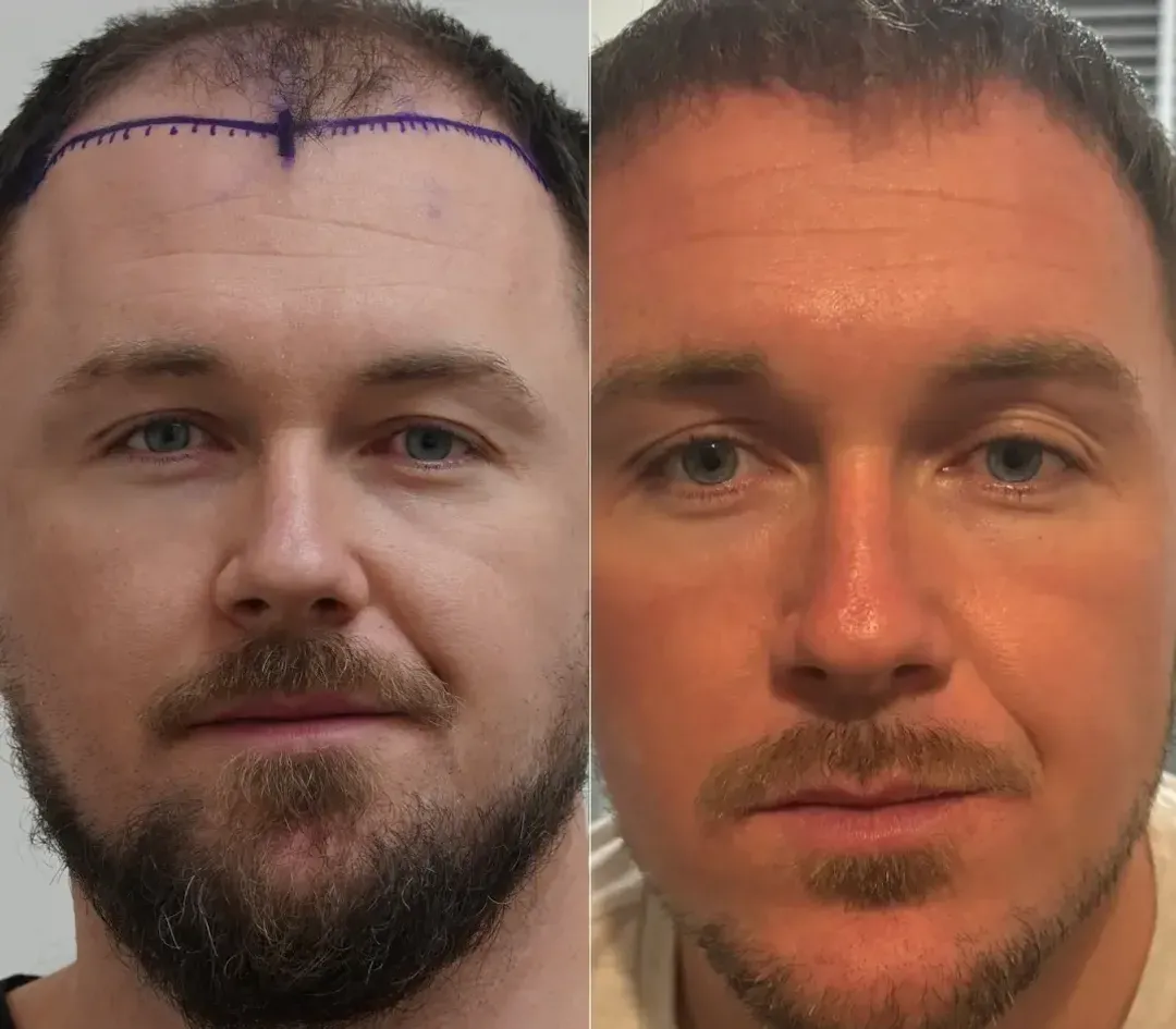 SAPPHIRE hair restoration result — 4,000 grafts