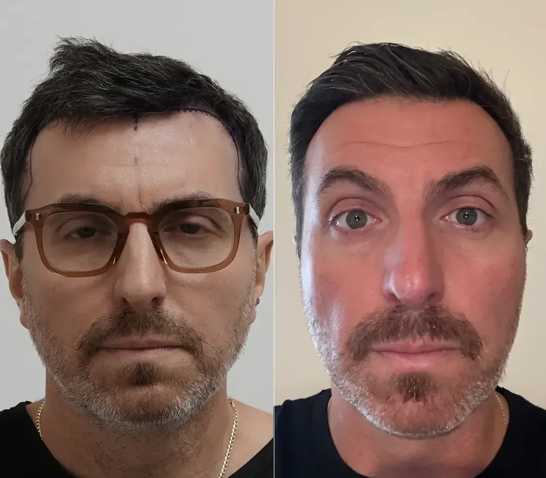 DHI hair restoration result — 3,200 grafts
