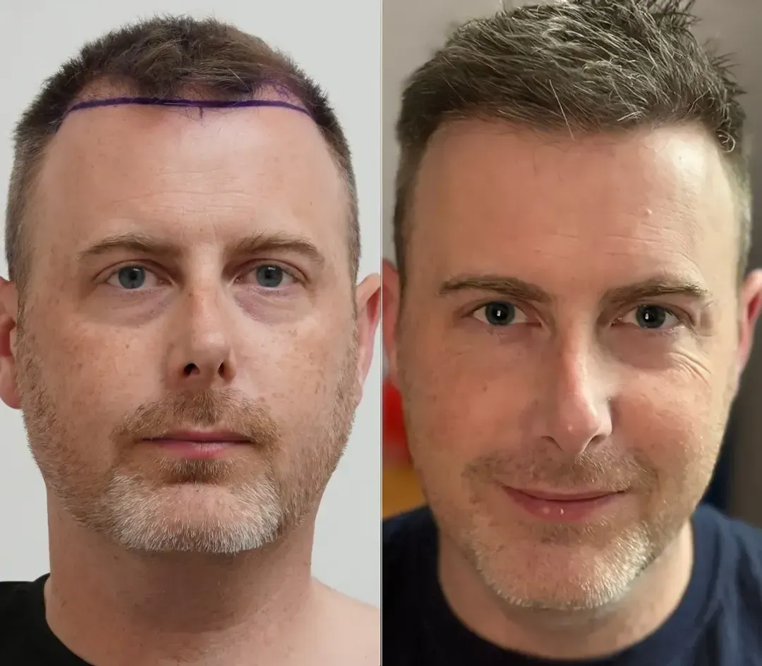 SAPPHIRE hair restoration result — 2,800 grafts