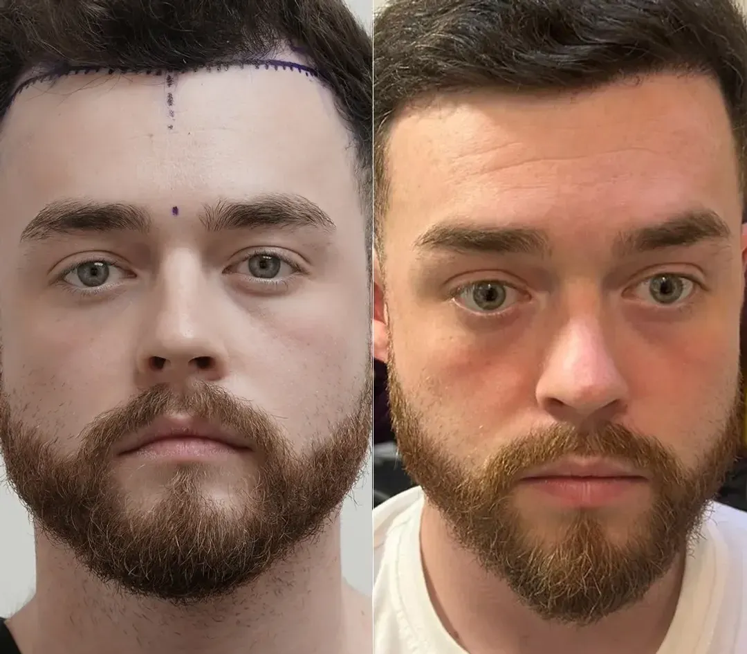 DHI hair restoration result — 2,400 grafts
