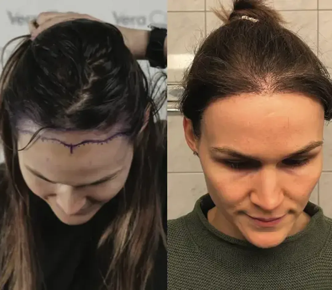 Female hair restoration result — 2,000 grafts