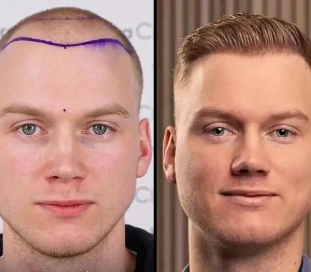 FUE hair restoration result — 2,400 grafts