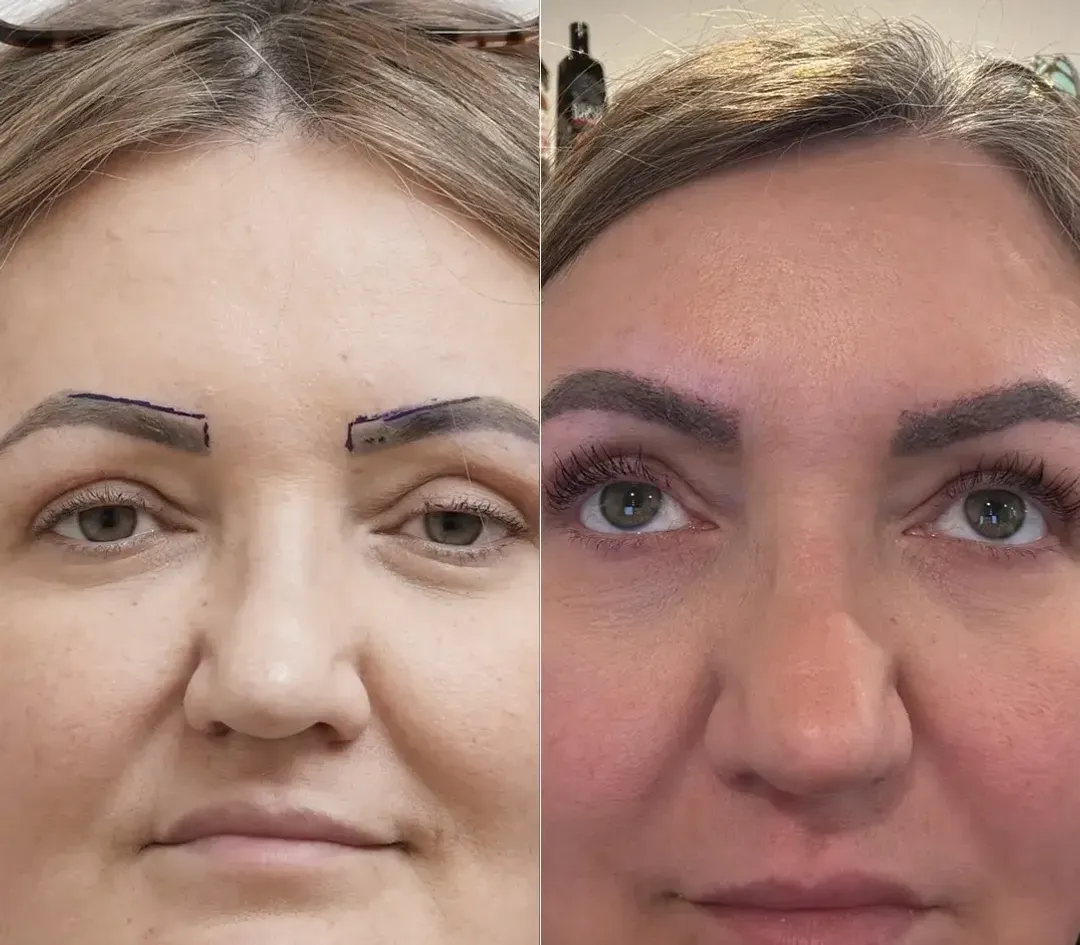 Female hair restoration result — 2,400 grafts
