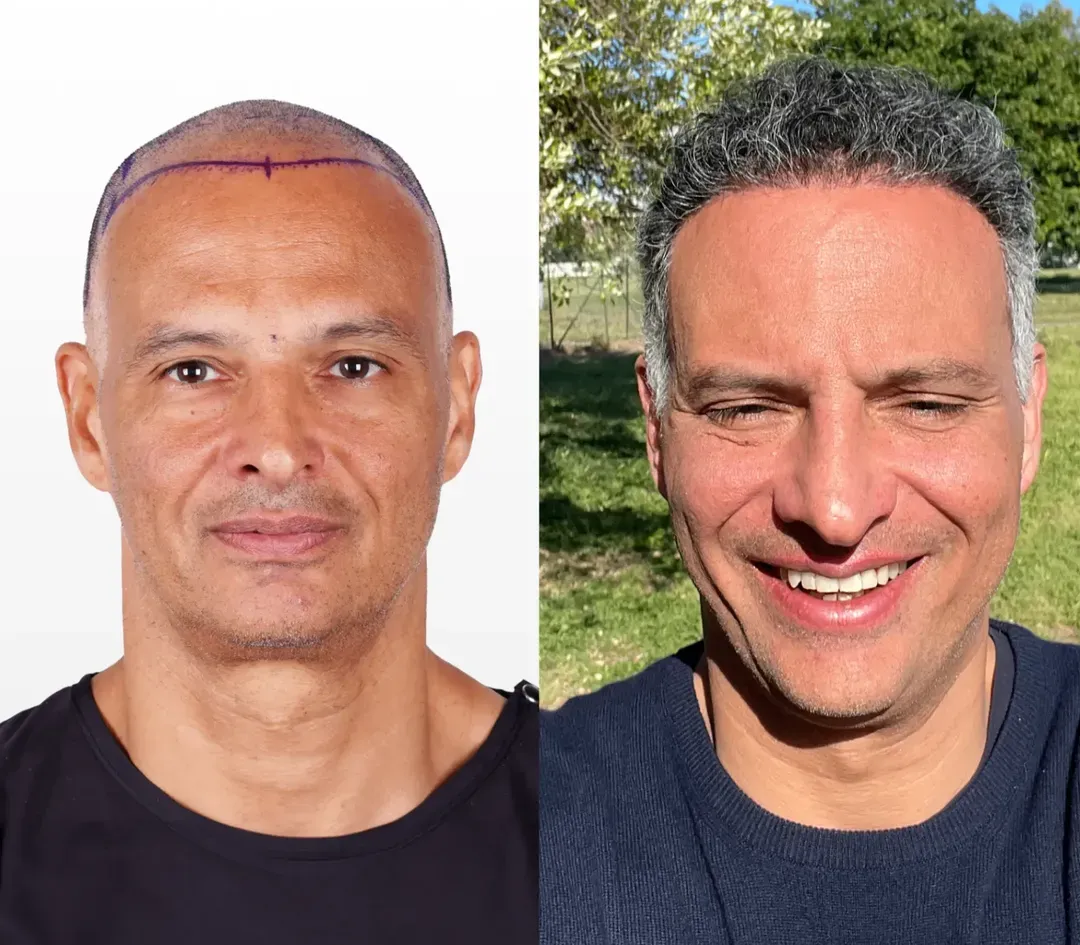SAPPHIRE hair restoration result — 2,400 grafts