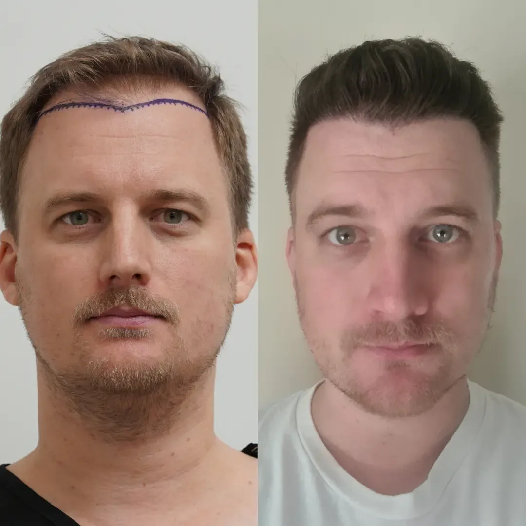 John D. before and after