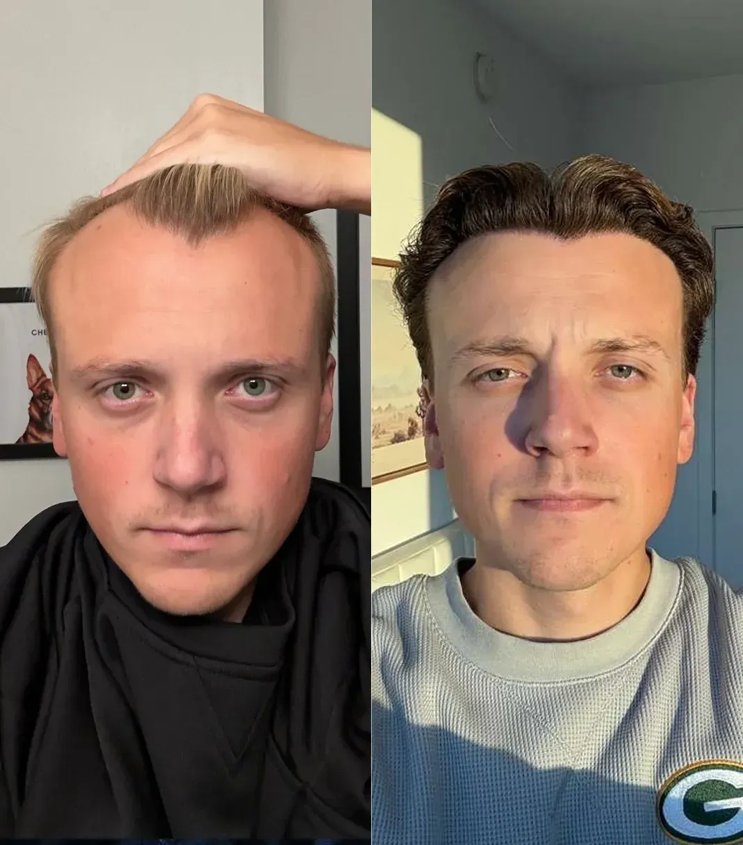 Marcus T. before and after